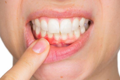 Bahan Alami, Inilah Pertologan Pertama pada Gusi Bengkak Versi SehatQ